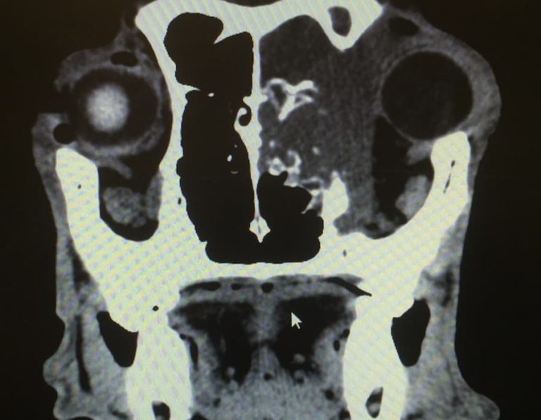 Mri Orbital Tumour